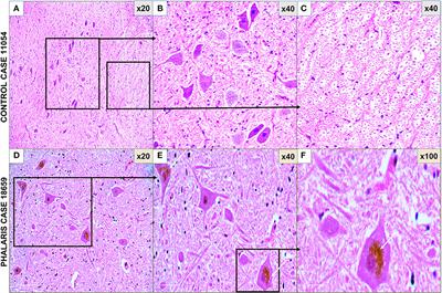 Case Report: Synucleinopathy Associated With Phalaris Neurotoxicity in Sheep